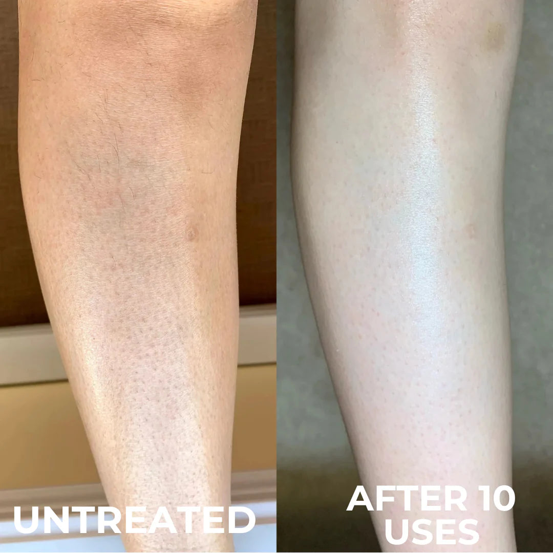 Complexe Triple Acide Avancé contre la Kératose Pilaire by Pelvien