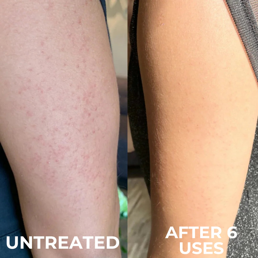 Complexe Triple Acide Avancé contre la Kératose Pilaire by Pelvien